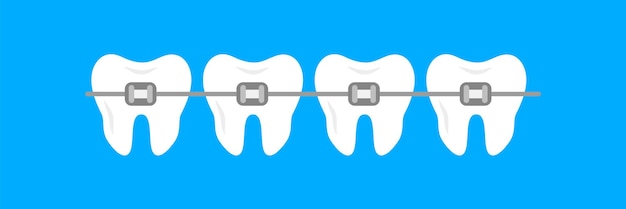 Vector frenos en los dientes. dientes blancos claros con brackets cerámicos. etapas del tratamiento de ortodoncia. alineación de dientes y corrección de mordida con la ayuda del sistema de ortodoncia. ilustración vectorial