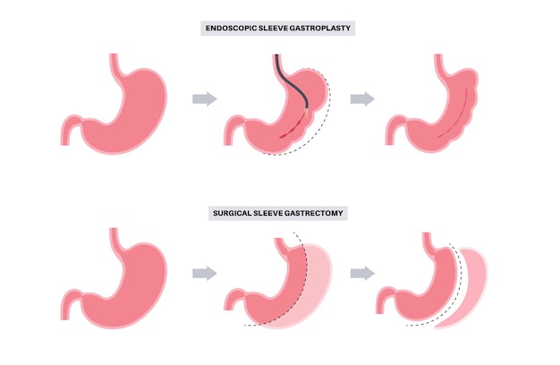 Vector gastroplastia de manga endoscópica y operación de gastrectomía cirugía de estómago procedimiento gástrico de pérdida de peso concepto de laparoscopia problema de sobrepeso en el cuerpo humano ilustración médica de vector plano