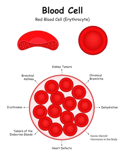 Vector glóbulos glóbulos rojos eritrocitos tumores renales defectos cardíacos eritremia deshidratación