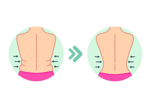 La grasa en la espalda se pliega en los lados de las mujeres antes y después de una dieta o una liposucción