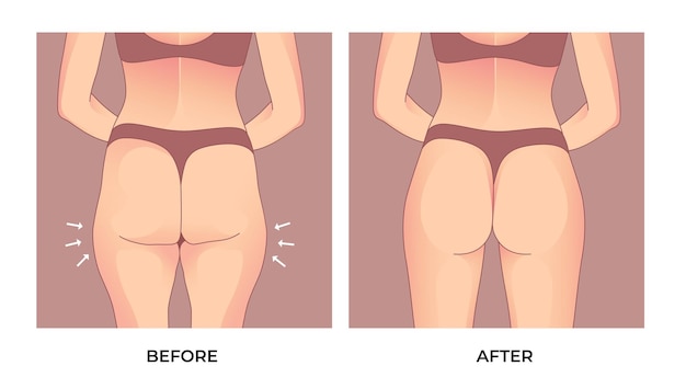 Grasa del muslo. antes y después de la pérdida de peso, transformación de la forma del cuerpo de la mujer, fat to fit.