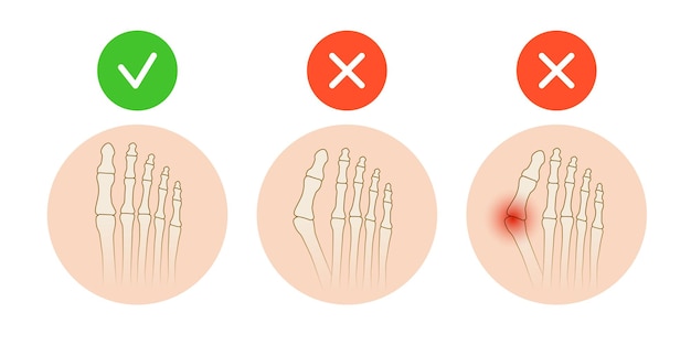 Hallux valgus Deformidad valgus de la articulación del dedo gordo del pie Ilustración vectorial