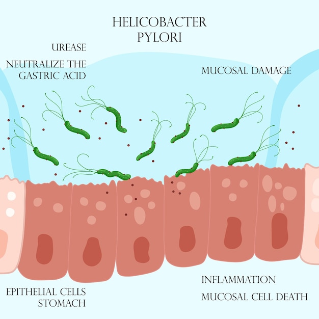 Helicobacter pylori en la capa mucosa de las células epiteliales inflamadas en el estómago