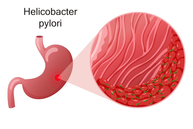 Helicobacter pylori en el estómago bajo magnificación Estilo de dibujos animados de ilustración vectorial detallada