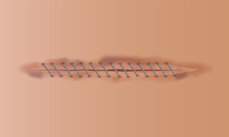 Vector heridas curativas cicatriz de piel cosida corte y corte sutura quirúrgica realista cosidas heridas etapa de curación en la piel humana fondo ilustración vectorial