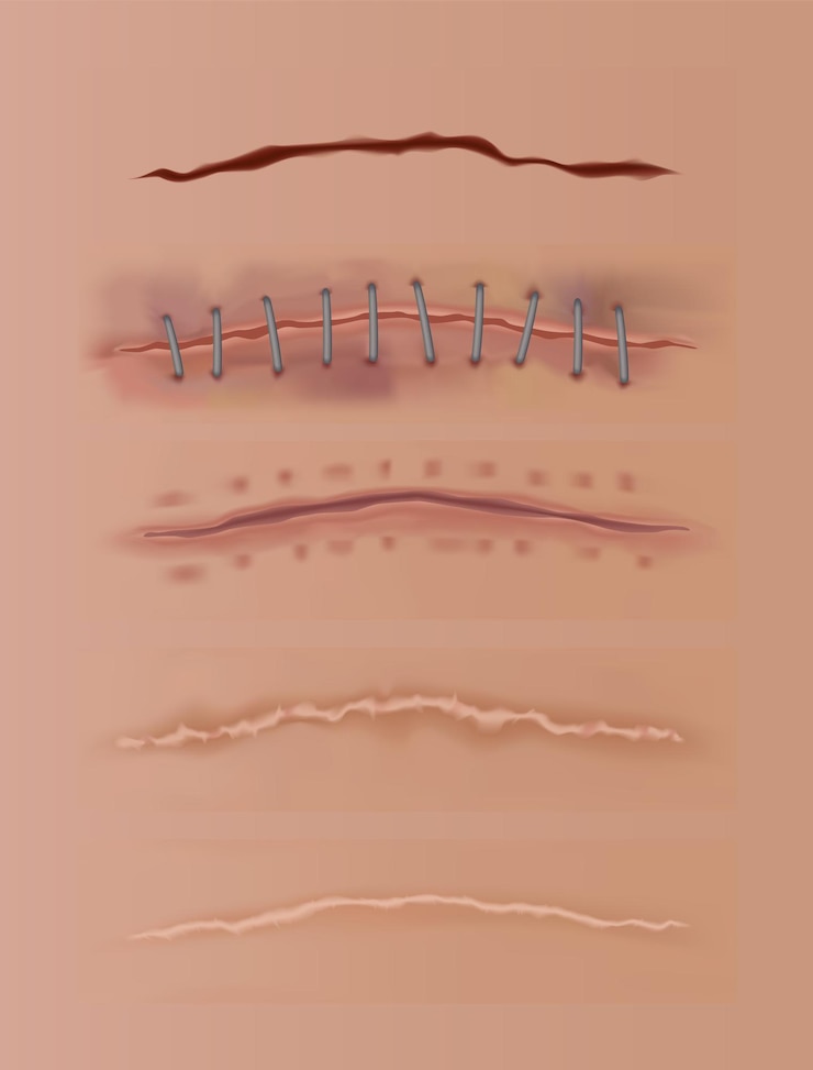 Vector las heridas curativas establecen cicatrices en la piel cosidas y cortadas suturas quirúrgicas realistas cosidas heridas en diferentes etapas de curación en el fondo de la piel humana