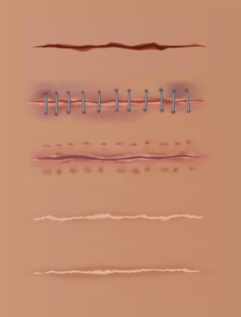 Las heridas curativas establecen cicatrices en la piel cosidas y cortadas suturas quirúrgicas realistas cosidas heridas en diferentes etapas de curación en el fondo de la piel humana