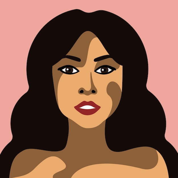 Hermosa mujer joven con vitiligo, enfermedad de la piel, imagen vectorial en estilo minimalista con ojos marrones