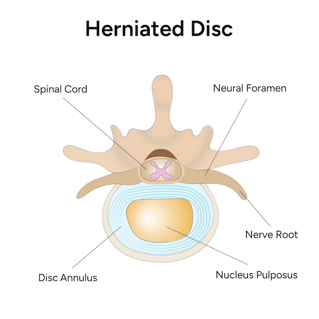 Hernia de disco en vector