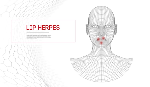 Herpes en labios. Herpes de mujer en la cara con tratamiento frío en los labios.