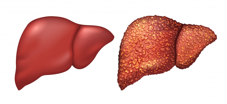 Vector hígado de persona sana. pacientes hepáticos con hepatitis. el hígado es una persona enferma. cirrosis del hígado. alcoholismo de repercusión