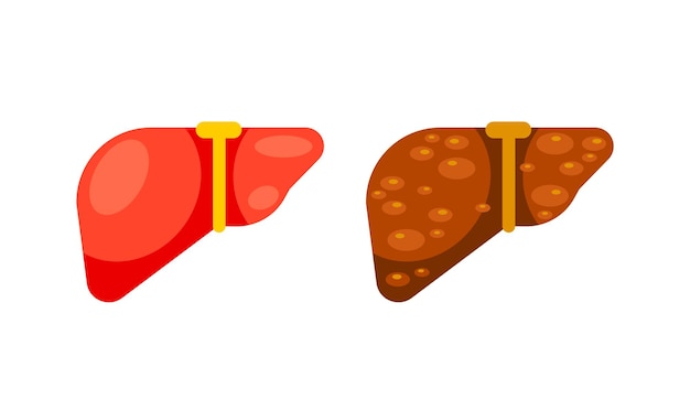 Hígado sano y enfermedad de cirrosis hepática Órgano hepático humano Ilustración vectorial