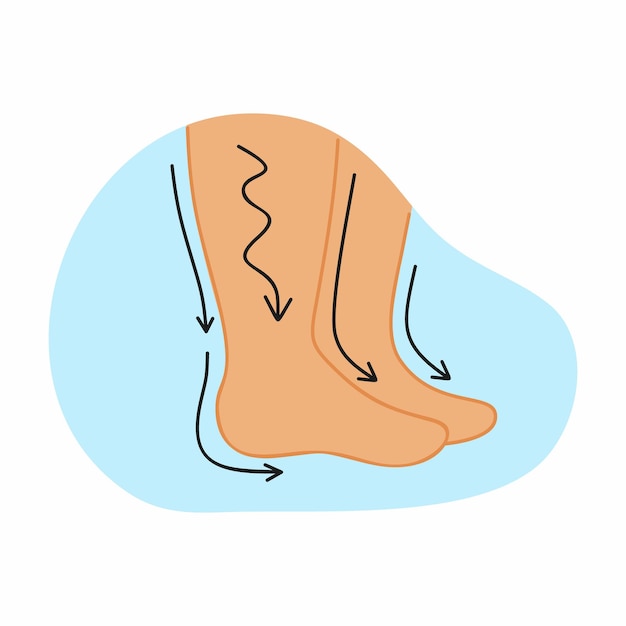Hinchazón de piernas y pies humanos. ilustración de vector sobre el tema de la medicina.