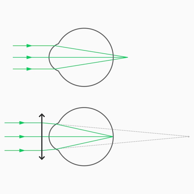 Vector hipermetropía (hipermetropía, hipermetropía) y corrección de la hipermetropía con gafas