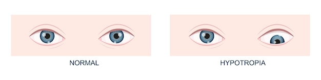 Hipotropía. Estrabismo vertical. Ojos humanos sanos y con posición de mirada hacia abajo Visión doble