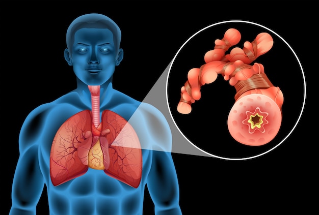 Hombre humano con tumor en pulmones