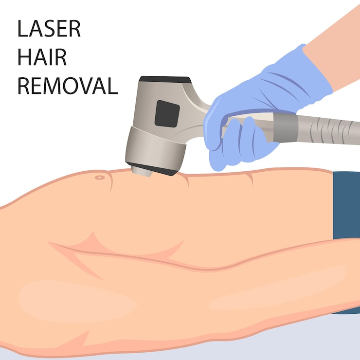 Vector un hombre con el pecho desnudo se somete a un procedimiento de depilación con láser para un cuerpo hermoso y suave