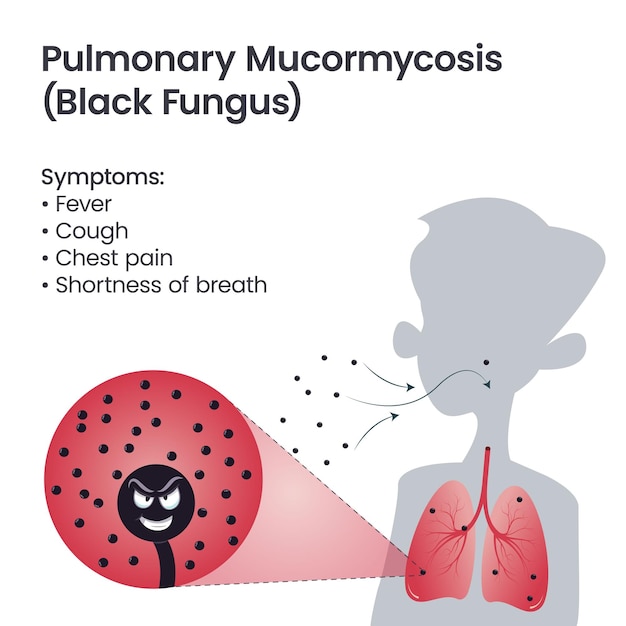Hongo negro pulmonar o mucormicosis dibujos animados vector ilustración infografía