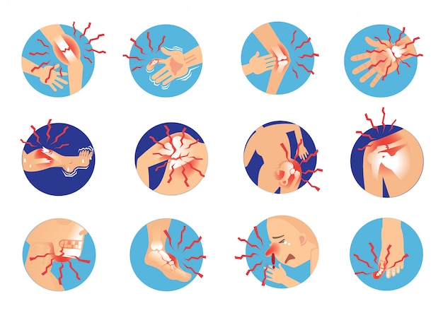 Vector hueso roto. fractura oblicua de huesos humanos dolor severo anatomía.