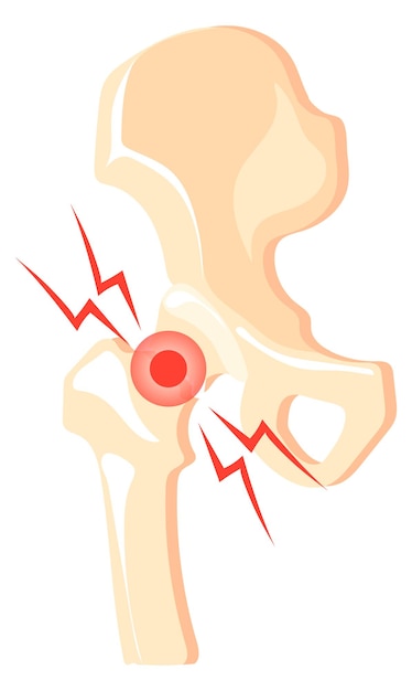 Vector icono de dolor en las articulaciones de la cadera dolor de huesos de dibujos animados