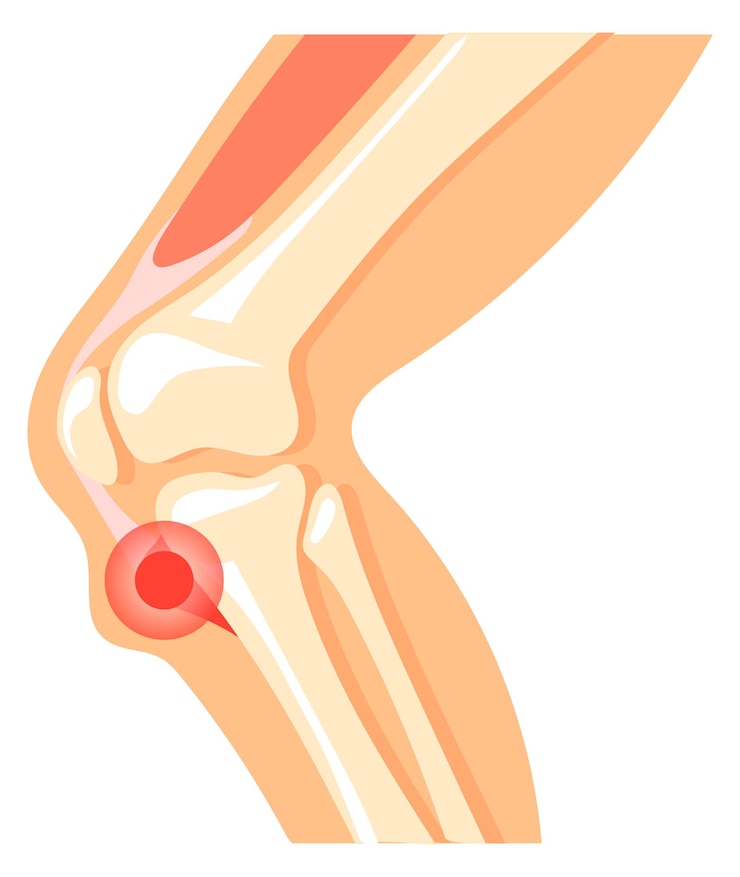 Vector icono de dolor de rodilla anatomía de la pierna con mancha roja