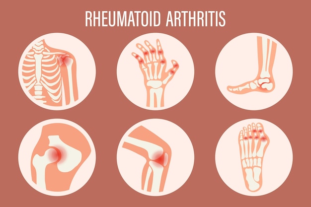 Vector iconos de artritis reumatoide articulación de la rodilla articulación del hombro articulación de la muñeca articulación de la cadera articulación del pie