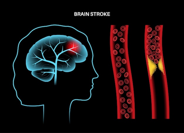 Vector ictus cerebral isquémico