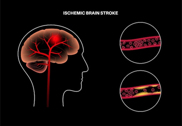 Vector ictus cerebral isquémico