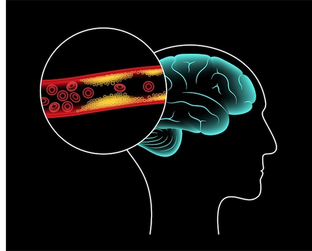 Vector ictus cerebral isquémico