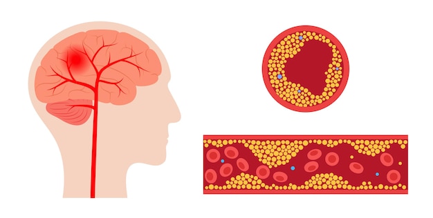 Vector ictus cerebral isquémico