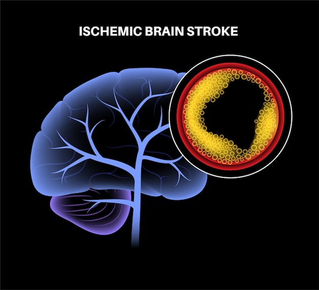 Vector ictus cerebral isquémico