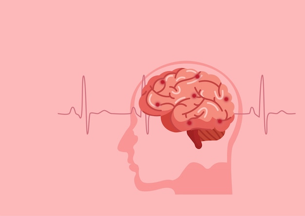 Ilustración de accidente cerebrovascular humano.