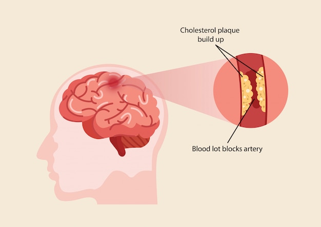 Vector ilustración de accidente cerebrovascular humano.