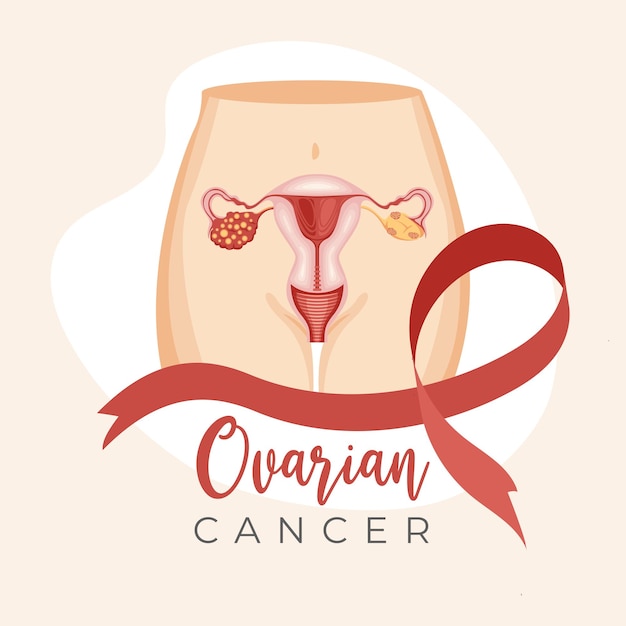 Ilustración de cáncer de ovario