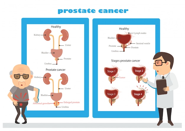 Ilustración de cáncer de próstata