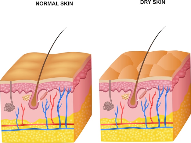 Ilustración de las capas de piel normal y piel seca