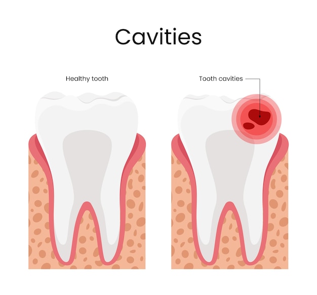 Ilustración de caries diente sano y caries dentales