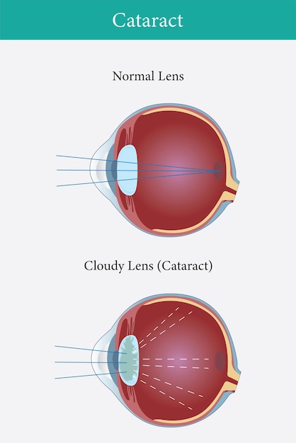 Ilustración de la catarata en los ojos humanos trastorno de la visión ocular vector ilustración eps 10