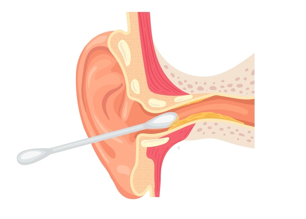 Vector ilustración de cómo limpiar el canal auditivo con un hisopo de algodón