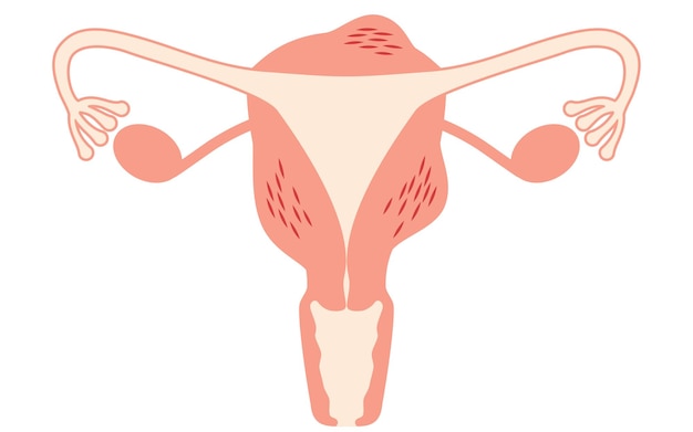 Vector ilustración diagramática de la anatomía de la adenomiosis del útero y los ovarios