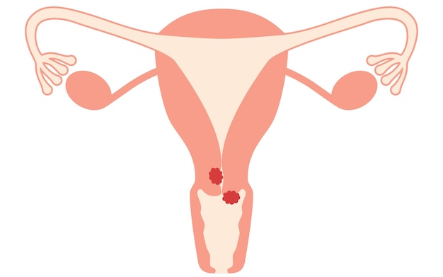 Vector ilustración diagramática de la anatomía del cáncer cervical del útero y los ovarios