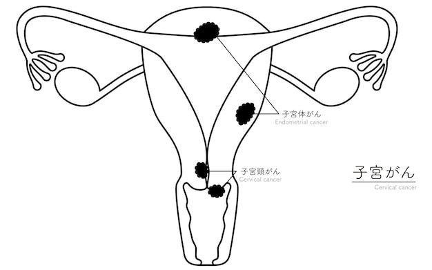 Vector ilustración diagramática de la anatomía del cáncer cervical del útero y los ovarios