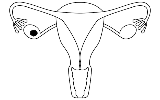 Ilustración diagramática de la anatomía del cáncer de ovario en la etapa I del útero y los ovarios