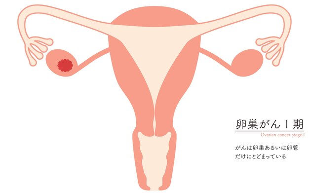 Vector ilustración diagramática de la anatomía del cáncer de ovario en la etapa i del útero y los ovarios