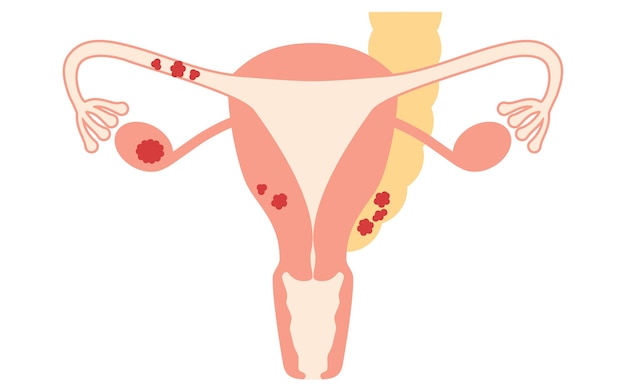 Vector ilustración diagramática de la anatomía del cáncer de ovario en la etapa ii del útero y los ovarios