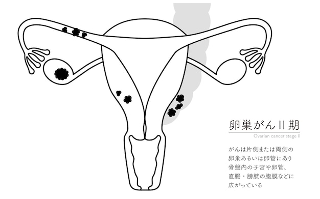 Vector ilustración diagramática de la anatomía del cáncer de ovario en la etapa ii del útero y los ovarios