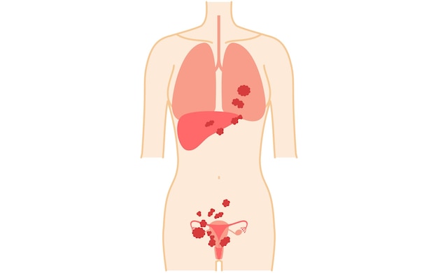 Vector ilustración diagramática de la anatomía del cáncer de ovario en la etapa iv del útero y los ovarios