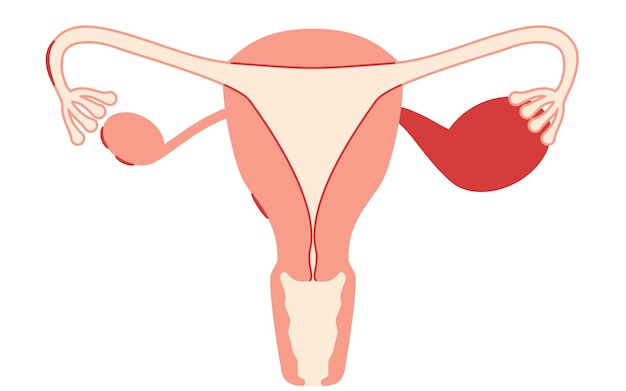 Ilustración diagramática de la anatomía de la endometriosis del útero y los ovarios