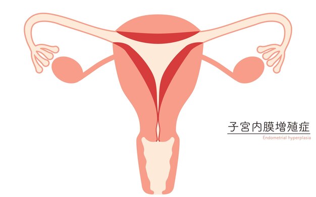 Ilustración diagramática de la anatomía de la hiperplasia endometrial del útero y los ovarios