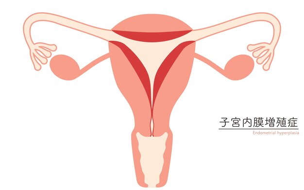 Vector ilustración diagramática de la anatomía de la hiperplasia endometrial del útero y los ovarios